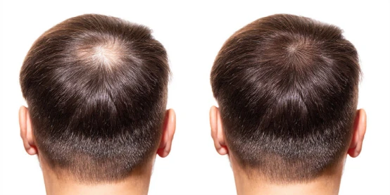 minoxidil a
