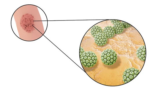 Podophyllin resin and HPV Podophyllin resin and HPV