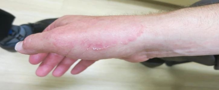 Cutaneous Fungal Infections