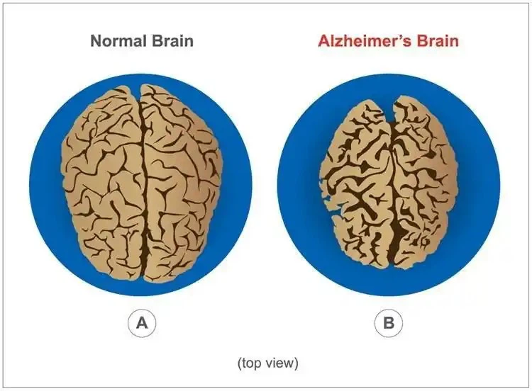Alzheimers-1